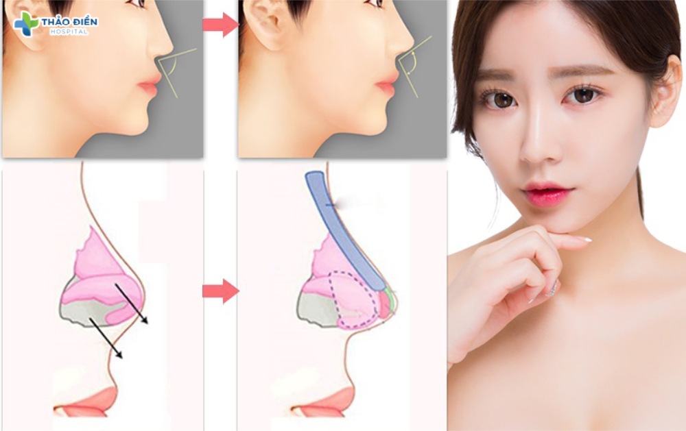 nâng mũi có ảnh hưởng đến sức khỏe không