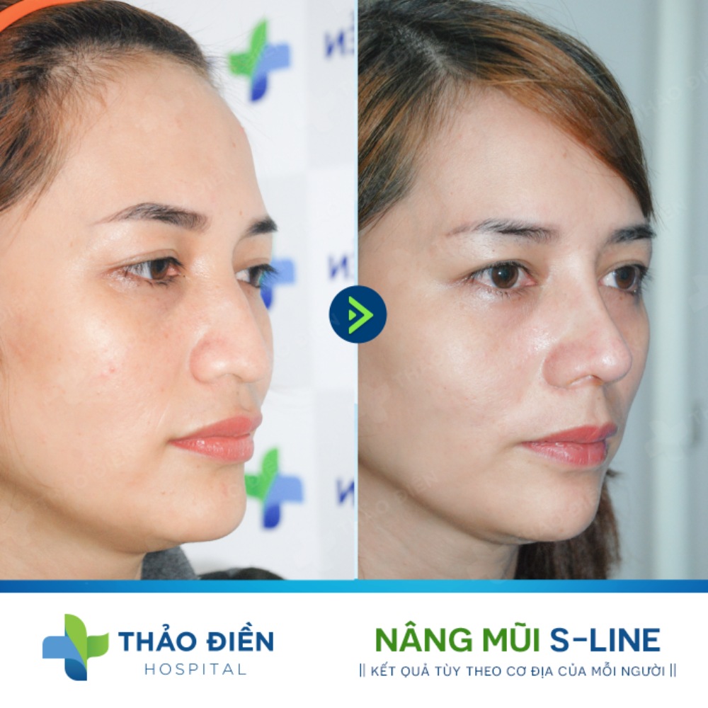 nâng mũi có ảnh hưởng gì về sau không